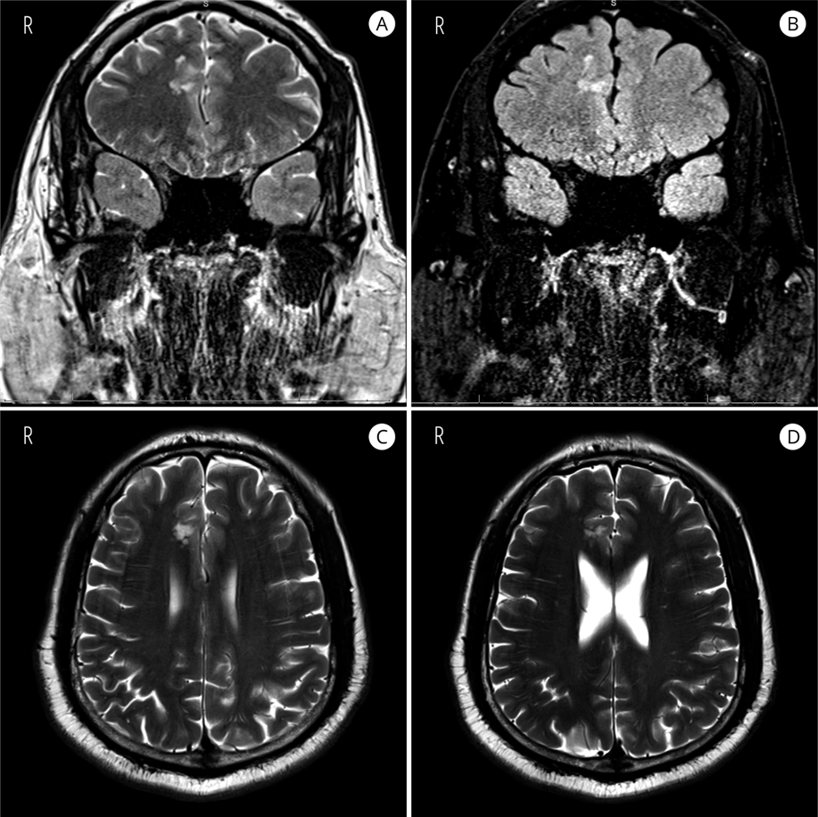 MRI: Multiple hyperintense nodules in the right parasagittal frontal lobe on T2 (A, C, and D) and T2 FLAIR (B). 