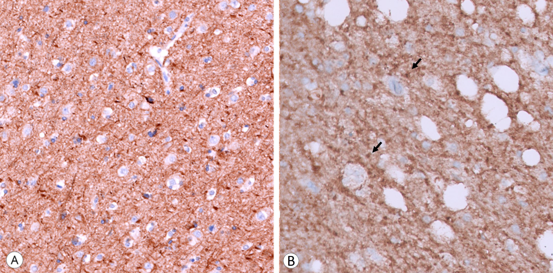 IHC: Neurofilament staining highlights the neuropil (A, 20x), and synaptophysin immunostaining shows strong positivity in tumor cells (arrows) (B, 40x). 